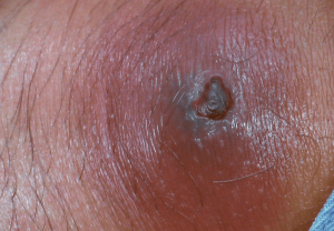 蜂窩織炎の症状の写真 膿 2