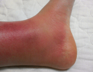 蜂窩織炎の症状の写真 足の腫れ